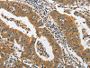 The image on the left is immunohistochemistry of paraffin-embedded Human gastric cancer tissue using CSB-PA622420 (PIK3R3 Antibody) at dilution 1/45, on the right is treated with synthetic peptide. (Original magnification: ×200)