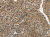 The image on the left is immunohistochemistry of paraffin-embedded Human liver cancer tissue using CSB-PA540033 (PIP5K1C Antibody) at dilution 1/25, on the right is treated with synthetic peptide. (Original magnification: ×200)