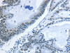 The image on the left is immunohistochemistry of paraffin-embedded Human colon cancer tissue using CSB-PA225643 (NEK4 Antibody) at dilution 1/25, on the right is treated with synthetic peptide. (Original magnification: ×200)