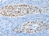 The image on the left is immunohistochemistry of paraffin-embedded Human cervical cancer tissue using CSB-PA079753 (NEK4 Antibody) at dilution 1/20, on the right is treated with synthetic peptide. (Original magnification: ×200)