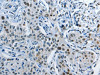 The image on the left is immunohistochemistry of paraffin-embedded Human lung cancer tissue using CSB-PA079753 (NEK4 Antibody) at dilution 1/20, on the right is treated with synthetic peptide. (Original magnification: ×200)