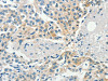 The image on the left is immunohistochemistry of paraffin-embedded Human breast cancer tissue using CSB-PA962705 (DGKB Antibody) at dilution 1/60, on the right is treated with synthetic peptide. (Original magnification: ×200)