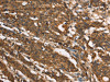 The image on the left is immunohistochemistry of paraffin-embedded Human gastic cancer tissue using CSB-PA898405 (MARC1 Antibody) at dilution 1/40, on the right is treated with synthetic peptide. (Original magnification: ×200)