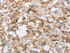 The image on the left is immunohistochemistry of paraffin-embedded Human thyroid cancer tissue using CSB-PA898405 (MARC1 Antibody) at dilution 1/40, on the right is treated with synthetic peptide. (Original magnification: ×200)