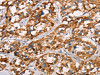 The image on the left is immunohistochemistry of paraffin-embedded Human thyroid cancer tissue using CSB-PA262747 (SPR Antibody) at dilution 1/40, on the right is treated with synthetic peptide. (Original magnification: ×200)