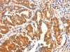 The image on the left is immunohistochemistry of paraffin-embedded Human gastic cancer tissue using CSB-PA219365 (AK5 Antibody) at dilution 1/60, on the right is treated with synthetic peptide. (Original magnification: ×200)