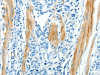 The image on the left is immunohistochemistry of paraffin-embedded Human gastic cancer tissue using CSB-PA589152 (CAV3 Antibody) at dilution 1/30, on the right is treated with synthetic peptide. (Original magnification: ×200)