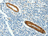 The image on the left is immunohistochemistry of paraffin-embedded Human gastic cancer tissue using CSB-PA057927 (CAV3 Antibody) at dilution 1/40, on the right is treated with synthetic peptide. (Original magnification: ×200)