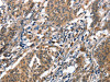 The image on the left is immunohistochemistry of paraffin-embedded Human gastic cancer tissue using CSB-PA192309 (ALOX15 Antibody) at dilution 1/50, on the right is treated with synthetic peptide. (Original magnification: ×200)