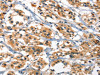 The image on the left is immunohistochemistry of paraffin-embedded Human thyroid cancer tissue using CSB-PA366900 (DEFA1/3 Antibody) at dilution 1/30, on the right is treated with synthetic peptide. (Original magnification: ×200)
