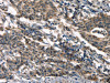 The image on the left is immunohistochemistry of paraffin-embedded Human gastic cancer tissue using CSB-PA245088 (DEFA5 Antibody) at dilution 1/15, on the right is treated with synthetic peptide. (Original magnification: ×200)