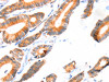 The image on the left is immunohistochemistry of paraffin-embedded Human colon cancer tissue using CSB-PA435775 (SCNN1A Antibody) at dilution 1/30, on the right is treated with synthetic peptide. (Original magnification: ×200)