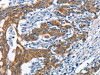 The image on the left is immunohistochemistry of paraffin-embedded Human gastic cancer tissue using CSB-PA940735 (MMP2 Antibody) at dilution 1/60, on the right is treated with synthetic peptide. (Original magnification: ×200) The image on the left is immunohistochemistry of paraffin-embedded Human gastic cancer tissue using CSB-PA940735 (MMP2 Antibody) at dilution 1/60, on the right is treated with synthetic peptide. (Original magnification: ×200)