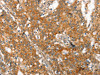 The image on the left is immunohistochemistry of paraffin-embedded Human gastic cancer tissue using CSB-PA211774 (MMP2 Antibody) at dilution 1/60, on the right is treated with synthetic peptide. (Original magnification: ×200)