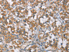 The image on the left is immunohistochemistry of paraffin-embedded Human thyroid cancer tissue using CSB-PA295852 (TLR6 Antibody) at dilution 1/25, on the right is treated with synthetic peptide. (Original magnification: ×200)