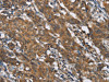 The image on the left is immunohistochemistry of paraffin-embedded Human gastric cancer tissue using CSB-PA295852 (TLR6 Antibody) at dilution 1/25, on the right is treated with synthetic peptide. (Original magnification: ×200)