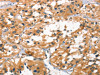 The image on the left is immunohistochemistry of paraffin-embedded Human thyroid cancer tissue using CSB-PA039919 (SMAD3 Antibody) at dilution 1/25, on the right is treated with synthetic peptide. (Original magnification: ×200)