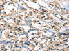 The image on the left is immunohistochemistry of paraffin-embedded Human thyroid cancer tissue using CSB-PA033427 (SMAD3 Antibody) at dilution 1/30, on the right is treated with synthetic peptide. (Original magnification: ×200)