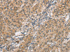The image on the left is immunohistochemistry of paraffin-embedded Human gastric cancer tissue using CSB-PA841004 (SMAD1 Antibody) at dilution 1/40, on the right is treated with synthetic peptide. (Original magnification: ×200)