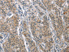The image on the left is immunohistochemistry of paraffin-embedded Human gastic cancer tissue using CSB-PA994185 (MAPT Antibody) at dilution 1/25, on the right is treated with synthetic peptide. (Original magnification: ×200)