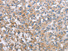 The image on the left is immunohistochemistry of paraffin-embedded Human thyroid cancer tissue using CSB-PA256752 (MCL1 Antibody) at dilution 1/60, on the right is treated with synthetic peptide. (Original magnification: ×200)