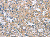 The image on the left is immunohistochemistry of paraffin-embedded Human thyroid cancer tissue using CSB-PA438059 (MCL1 Antibody) at dilution 1/60, on the right is treated with synthetic peptide. (Original magnification: ×200)