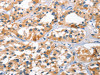 The image on the left is immunohistochemistry of paraffin-embedded Human thyroid cancer tissue using CSB-PA570255 (BNIP3L Antibody) at dilution 1/40, on the right is treated with synthetic peptide. (Original magnification: ×200)