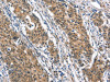 The image on the left is immunohistochemistry of paraffin-embedded Human gastric cancer tissue using CSB-PA570255 (BNIP3L Antibody) at dilution 1/40, on the right is treated with synthetic peptide. (Original magnification: ×200)