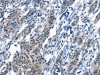 The image on the left is immunohistochemistry of paraffin-embedded Human gastic cancer tissue using CSB-PA598205 (BNIP3L Antibody) at dilution 1/30, on the right is treated with synthetic peptide. (Original magnification: ×200)