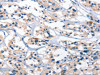 The image on the left is immunohistochemistry of paraffin-embedded Human thyroid cancer tissue using CSB-PA598205 (BNIP3L Antibody) at dilution 1/30, on the right is treated with synthetic peptide. (Original magnification: ×200)