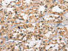 The image on the left is immunohistochemistry of paraffin-embedded Human thyroid cancer tissue using CSB-PA181048 (GPR182 Antibody) at dilution 1/30, on the right is treated with synthetic peptide. (Original magnification: ×200)