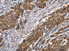 The image on the left is immunohistochemistry of paraffin-embedded Human gastic cancer tissue using CSB-PA573955 (ARSB Antibody) at dilution 1/50, on the right is treated with synthetic peptide. (Original magnification: ×200)