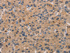 The image on the left is immunohistochemistry of paraffin-embedded Human liver cancer tissue using CSB-PA904637 (ATP7A Antibody) at dilution 1/50, on the right is treated with synthetic peptide. (Original magnification: ×200)