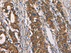 The image on the left is immunohistochemistry of paraffin-embedded Human gastric cancer tissue using CSB-PA277650 (CD80 Antibody) at dilution 1/50, on the right is treated with synthetic peptide. (Original magnification: ×200)