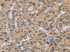 The image on the left is immunohistochemistry of paraffin-embedded Human liver cancer tissue using CSB-PA999579 (ADGRB2 Antibody) at dilution 1/25, on the right is treated with synthetic peptide. (Original magnification: ×200)