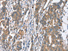 The image on the left is immunohistochemistry of paraffin-embedded Human gastric cancer tissue using CSB-PA546462 (SLC4A1 Antibody) at dilution 1/30, on the right is treated with synthetic peptide. (Original magnification: ×200)