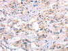 The image on the left is immunohistochemistry of paraffin-embedded Human thyroid cancer tissue using CSB-PA954798 (SLC4A1 Antibody) at dilution 1/15, on the right is treated with synthetic peptide. (Original magnification: ×200)