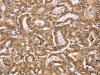 The image on the left is immunohistochemistry of paraffin-embedded Human thyroid cancer tissue using CSB-PA135204 (BGLAP Antibody) at dilution 1/40, on the right is treated with synthetic peptide. (Original magnification: ×200)