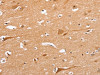 The image on the left is immunohistochemistry of paraffin-embedded Human brain tissue using CSB-PA195809 (BLNK Antibody) at dilution 1/50, on the right is treated with synthetic peptide. (Original magnification: ×200)