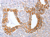 The image on the left is immunohistochemistry of paraffin-embedded Human cervical cancer tissue using CSB-PA048521 (ABO Antibody) at dilution 1/50, on the right is treated with synthetic peptide. (Original magnification: ×200)