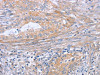 The image on the left is immunohistochemistry of paraffin-embedded Human cervical cancer tissue using CSB-PA911937 (BOD1 Antibody) at dilution 1/30, on the right is treated with synthetic peptide. (Original magnification: ×200)