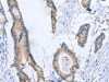 The image on the left is immunohistochemistry of paraffin-embedded Human colon cancer tissue using CSB-PA911937 (BOD1 Antibody) at dilution 1/30, on the right is treated with synthetic peptide. (Original magnification: ×200)
