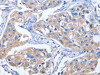 The image on the left is immunohistochemistry of paraffin-embedded Human breast cancer tissue using CSB-PA545336 (IBSP Antibody) at dilution 1/50, on the right is treated with synthetic peptide. (Original magnification: ×200)