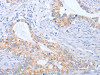 The image on the left is immunohistochemistry of paraffin-embedded Human cervical cancer tissue using CSB-PA159485 (BST1 Antibody) at dilution 1/50, on the right is treated with synthetic peptide. (Original magnification: ×200)