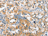 The image on the left is immunohistochemistry of paraffin-embedded Human thyroid cancer tissue using CSB-PA132003 (CACNA1C Antibody) at dilution 1/20, on the right is treated with synthetic peptide. (Original magnification: ×200)