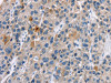 The image on the left is immunohistochemistry of paraffin-embedded Human liver cancer tissue using CSB-PA745307 (CACNA1D Antibody) at dilution 1/30, on the right is treated with synthetic peptide. (Original magnification: ×200)