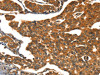 The image on the left is immunohistochemistry of paraffin-embedded Human breast cancer tissue using CSB-PA952659 (CACNA1E Antibody) at dilution 1/15, on the right is treated with synthetic peptide. (Original magnification: ×200)