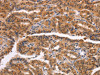 The image on the left is immunohistochemistry of paraffin-embedded Human thyroid cancer tissue using CSB-PA572077 (NCAPG2 Antibody) at dilution 1/50, on the right is treated with synthetic peptide. (Original magnification: ×200)