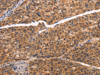The image on the left is immunohistochemistry of paraffin-embedded Human liver cancer tissue using CSB-PA572077 (NCAPG2 Antibody) at dilution 1/50, on the right is treated with synthetic peptide. (Original magnification: ×200)