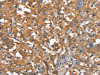 The image on the left is immunohistochemistry of paraffin-embedded Human thyroid cancer tissue using CSB-PA173074 (CAPZA1 Antibody) at dilution 1/25, on the right is treated with synthetic peptide. (Original magnification: ×200) The image on the left is immunohistochemistry of paraffin-embedded Human thyroid cancer tissue using CSB-PA173074 (CAPZA1 Antibody) at dilution 1/25, on the right is treated with synthetic peptide. (Original magnification: ×200)